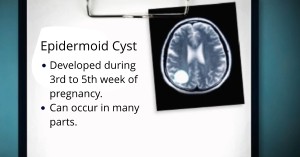 Epidermoid Cyst Treatment Newport Beach & Orange County, CA