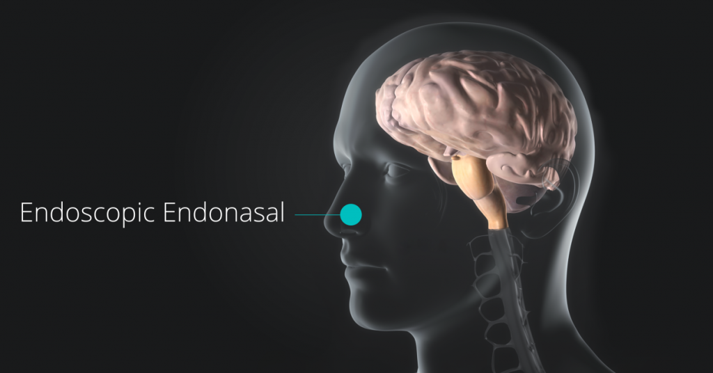 Endonasal Endoscopic Surgery Robert Louis Md 