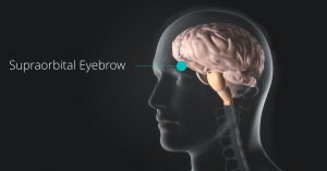 Supraorbital Eyebrow Craniotomy Approach Newport Beach & Orange County, CA