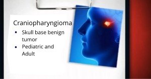 Craniopharyngioma Newport Beach & Orange County