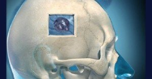 Meningioma Treatment Newport Beach & Orange County, CA