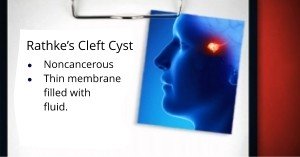 Rathke’s Cleft Cyst Removal in Orange County by Dr. Louis