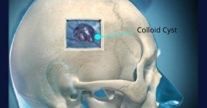 Robert Louis, MD, Colloid Cyst Treatment