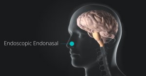 Endonasal Endoscopic Surgery Newport Beach & Orange County, CA