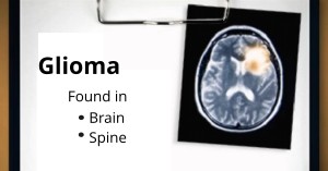 Glioma Newport Beach & Orange County, CA