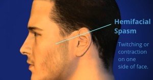 Hemifacial Spasm Newport Beach & Orange County, CA