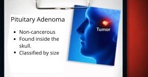 Pituitary Adenoma Treatment Newport Beach & Orange County