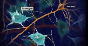 Astrocytoma Treatment in Orange County by Dr. Robert Louis