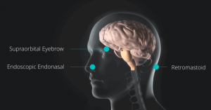 Minimally Invasive Keyhole Brain Surgery Newport Beach & Orange County