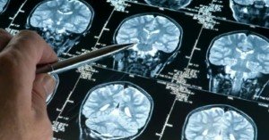 Ependymoma Newport Beach & Orange County, CA