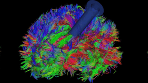 NICO Brain Path | Robert Louis, MD