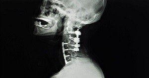 Posterior Cervical Fusion Newport Beach & Orange County, CA